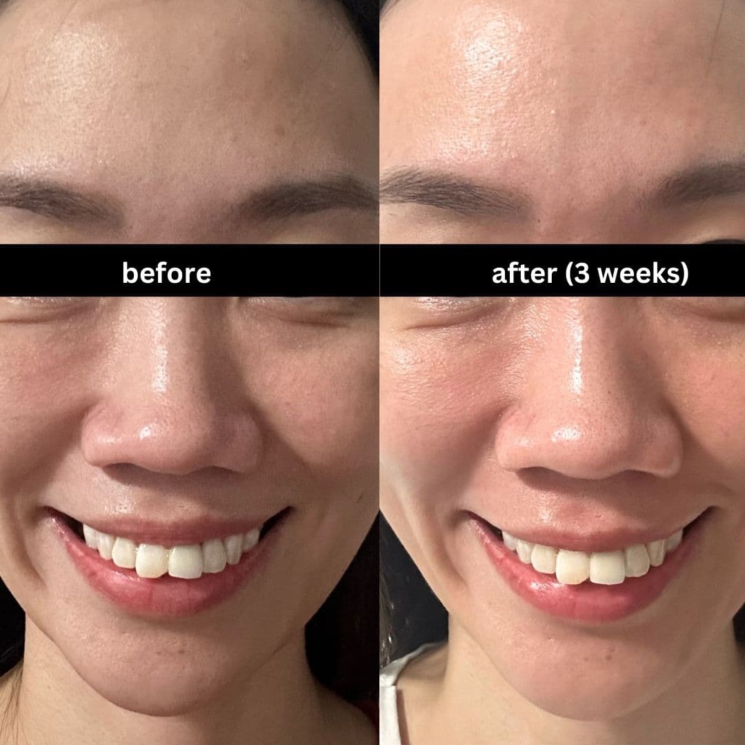 Derma Filler